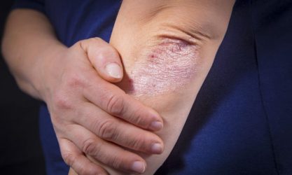 Ψώρα: Τι είναι, πως μεταδίδεται, ποια είναι η θεραπεία της