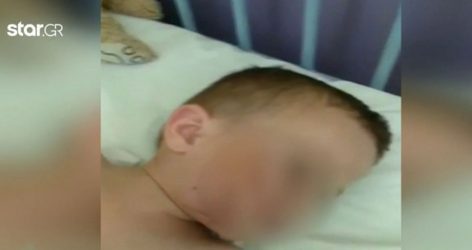 Σκύλος δάγκωσε στο πρόσωπο 4χρονο αγόρι