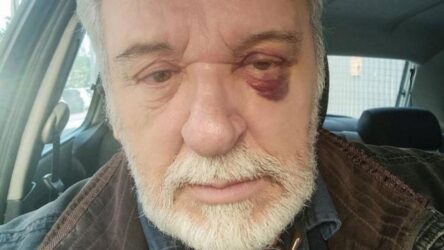 Με μελανιά στο μάτι ο Τάσος Χαλκιάς: «Αλλο ένα τραύμα, σωματικό αυτή τη φορά»