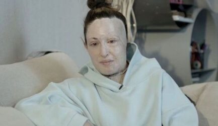 Συγκλόνισε η Ιωάννα Παλιοσπύρου: Εβγαλε τη μάσκα και μίλησε για την επίθεση με βιτριόλι (ΒΙΝΤΕΟ)