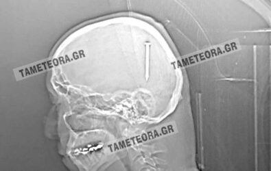 Καλαμπάκα: Ανδρας τραυματίστηκε στο κεφάλι με καρφί 5 εκατοστών (ΦΩΤΟ)