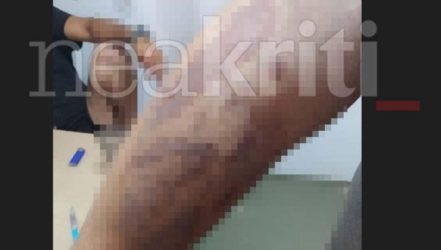 Σοκ: 22χρονος υπέστη εγκαύματα β’ βαθμού και επειδή δούλευε ανασφάλιστος δεν καλούσαν το ΕΚΑΒ
